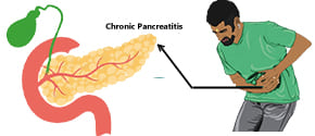 Chronic Pancreatitis