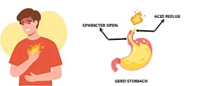 Gastroesophageal Reflux