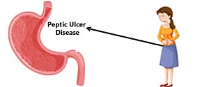 Peptic Ulcer Disease