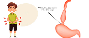 Achalasia